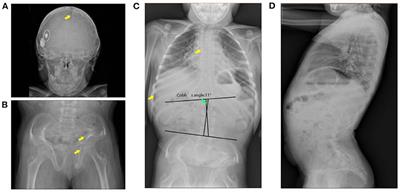 Case report: Clinical manifestations and genotype analysis of a child with PTPN11 and SEC24D mutations